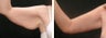 Arm Lift