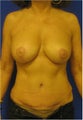 Breast Lift and Abdominoplasty