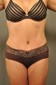 Abdominoplasty, Liposuction and Breast Augmentation