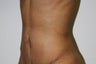 abdominoplasty