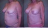 Tummy Tuck and Breast Augmentation