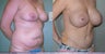 Tummy Tuck
