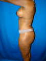 Breast Lift with Implants and Tummy Tuck (Abdominoplasty)