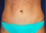 Tummy Tuck