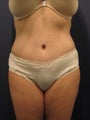 Tummy Tuck