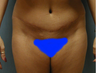 Mommy Makeover- Tummy Tuck and Breast Augmentation