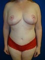 Breast Reduction, Mommy Makeover, Tummy Tuck (Abdominoplasty)