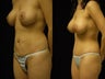 Abdominoplasty and breast augmentation