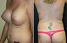 Breast Augmentation, Liposuction, Butt Lift