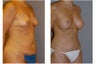 Mommy Makeover Surgery
