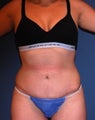 Tummy Tuck