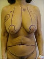 Breast Lift and Abdominoplasty