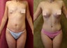 mommy makeover