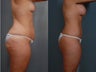 Mommy Makeover, Tummy Tuck, Liposuction, Breast Augmentation