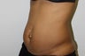 abdominoplasty