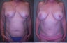 Tummy Tuck and Breast Augmentation