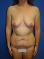 Breast Augmentation Liposuction and Abdominoplasty