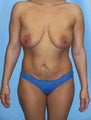 Breast Augmentation Mastopexy and Abdominoplasty