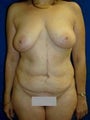Tummy Tuck (Abdominoplasty), Breast Lift with Implants, Mommy Makeover