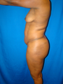 Breast Lift with Implants and Tummy Tuck (Abdominoplasty)