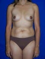 Belly Buttons, Tummy Tuck (Abdominoplasty), Breast Augmentation