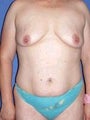Breast Augmentation, Tummy Tuck (Abdominoplasty), Mommy Makeover