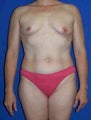 Tummy Tuck (Abdominoplasty), Breast Enhancement, Nipple-areola Repair, Mommy Makeover