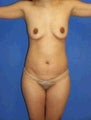 Tummy Tuck (Abdominoplasty), Breast Augmentation, Petite Frame Breast Augmentation, Mommy Makeover