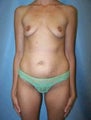 Tummy Tuck (Abdominoplasty), Breast Enhancement, Mommy Makeover