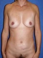 Breast Augmentation, Tummy Tuck (Abdominoplasty), Mommy Makeover