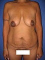 Tummy Tuck (Abdominoplasty), Breast Enhancement, Mommy Makeover