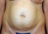 Tummy Tuck