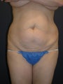 Tummy Tuck