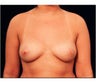 Mommy Makeover Nipple Correction