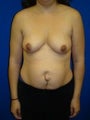 Breast Asymmetry, Tummy Tuck (Abdominoplasty), Belly Buttons, Breast Enhancement, Mommy Makeover