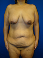Mommy Makeover, Breast Lift with Implants, Extended Tummy Tuck