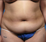 bilateral augmentation mammoplasty, abdominoplasty, and suction-assisted lipectomy of the flanks