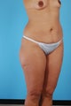 Tummy Tuck, Liposuction, Breast Augmentation
