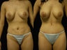 Abdominoplasty and breast augmentation