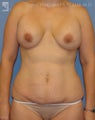 Revision of Breast & Abdominoplasty