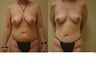 Mommy Makeover