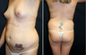 Breast Augmentation, Liposuction, Butt Lift