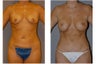 Mommy Makeover Surgery