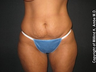 Tummy Tuck