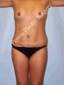 Mommy Makeover, Petite Frame Breast Augmentation, Silicone gel Implants, Tummy Tuck (Abdominoplasty)