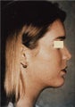 Chin Implant/Necklift/MiniLipo