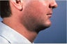 Necklift 