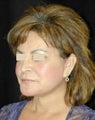 Facelift / Necklift 