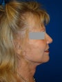 Face and Neck Lift Surgery