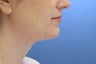 Neck Lift